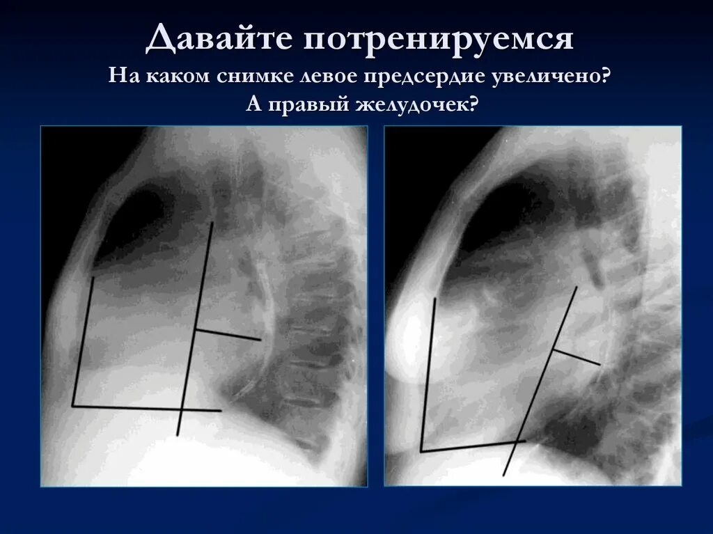 Гипертрофия правого предсердия рентген. Гипертрофия правого желудочка рентген. Гипертрофия левого предсердия рентген. Левое предсердие увеличено