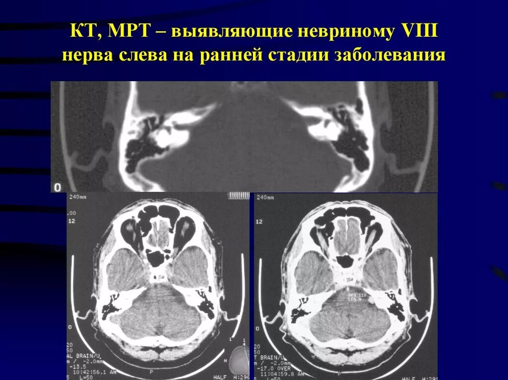 Мрт черепных нервов. Невринома слухового нерва на кт. Шваннома слухового нерва кт. Невринома мосто-мозжечкового угла кт.