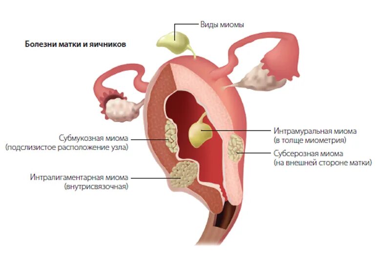 Симптомы рака эндометрия