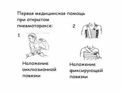 Окклюзионная повязка накладывается при