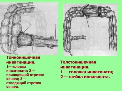 Кишечная непроходимость мкб