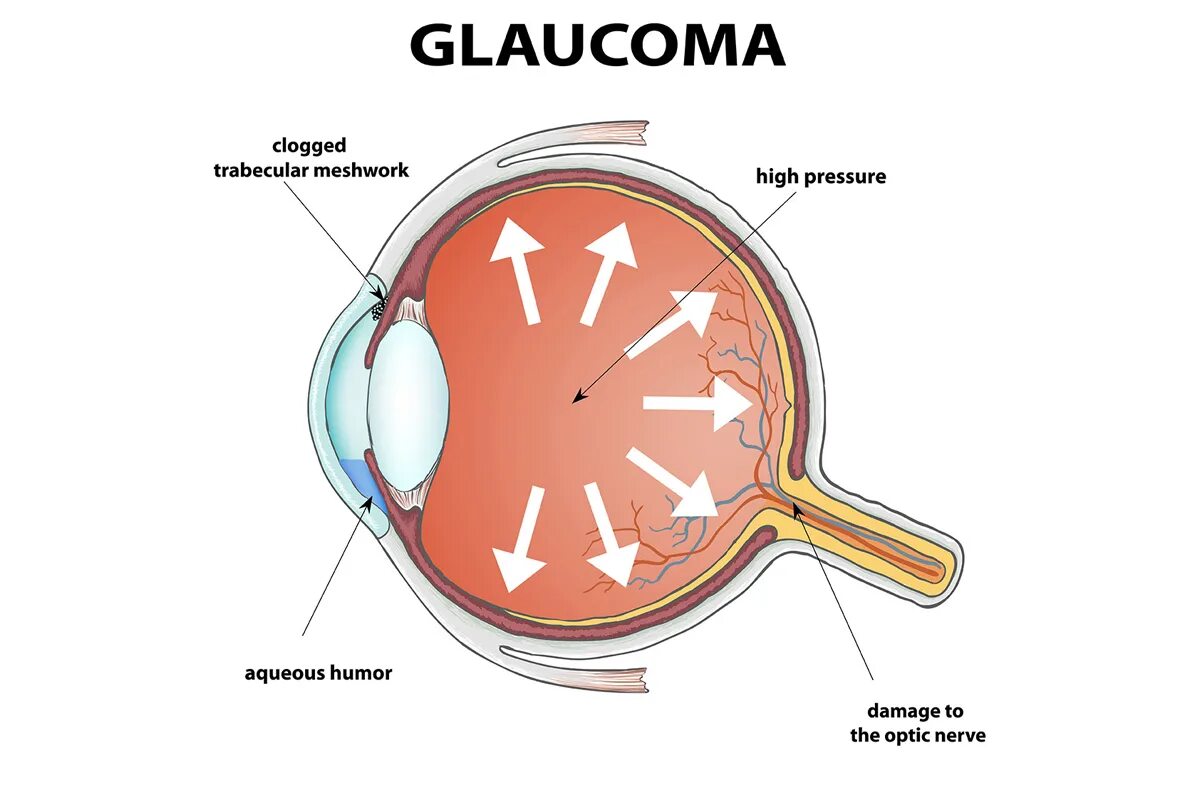 Глаукома латынь. Глаукома схема.