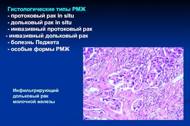 Инфильтрированная опухоль. Инфильтрирующая карцинома молочной железы гистология. Протоковая карцинома молочной железы микропрепарат. Инвазивная карцинома молочной железы микропрепарат. Инвазивная карцинома молочной железы g2.
