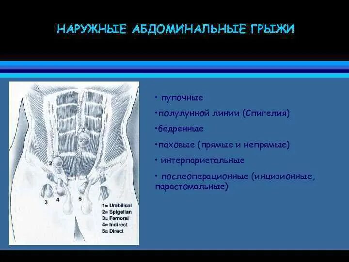 Грыжа спигелиевой линии. Грыжа спигелиевой линии