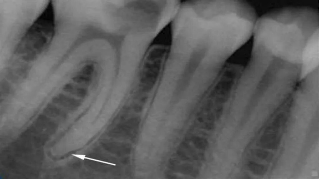 Фиброзный периодонтит. Хронический фиброзный пульпит рентген. Фиброзный периодонтит рентгенограмма. Межкорневой периодонтит. Гранулематозный апикальный периодонтит.