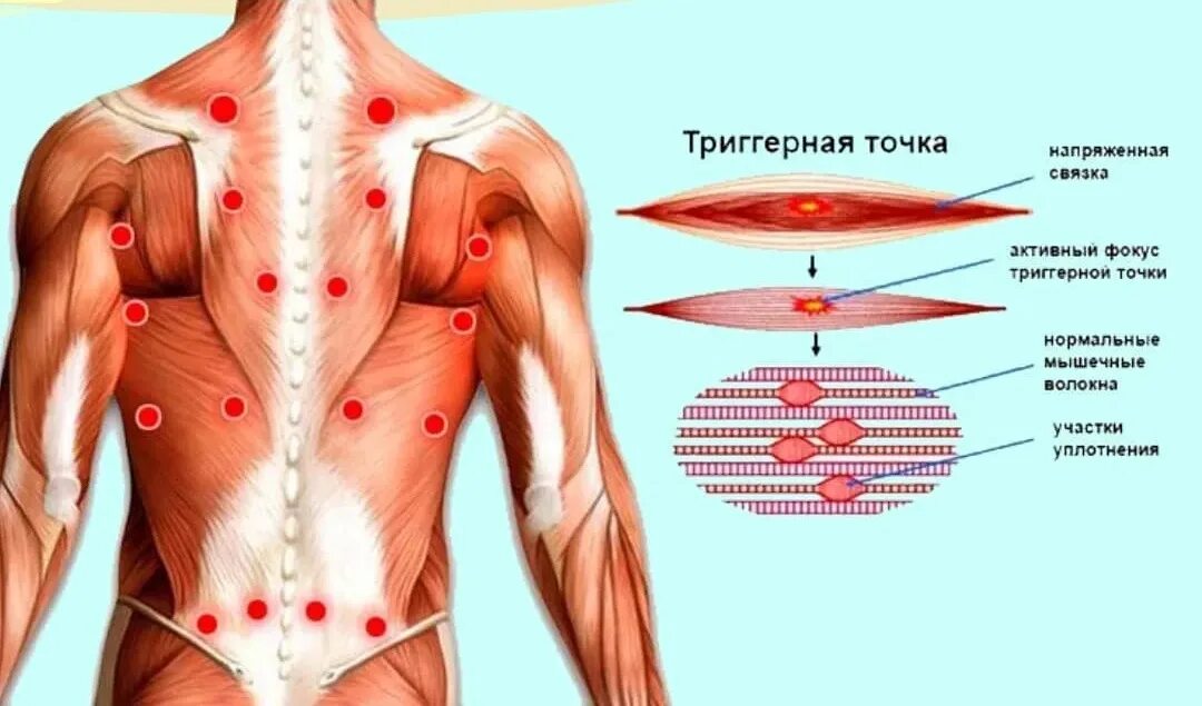Миофасциальный синдром триггерные точки. Карта триггерных точек. Триггеры в мышцах. Триггерные точки на спине. Триггерные точки это простыми словами