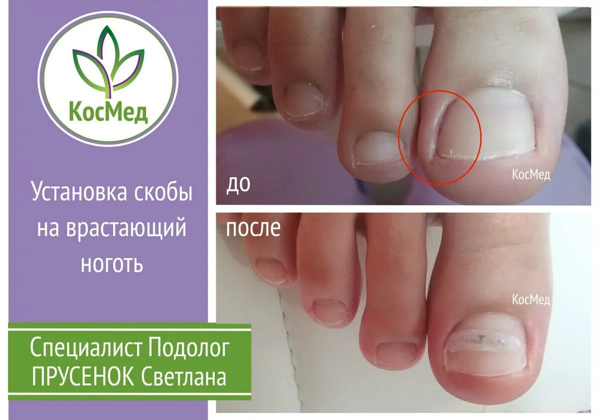 подолог листовка. педикюр обработка стопы. визитка подолога. подолог ярославль. подолог ярославль.