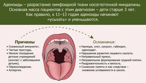 Периоды ангины