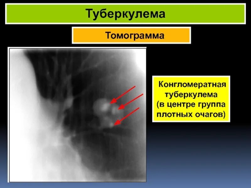 Плотный очаговый