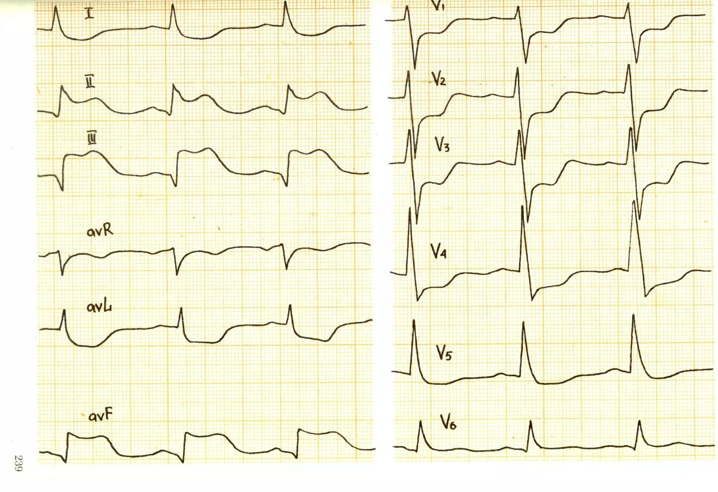St ишемия. Инфаркт миокарда v1-v3 ЭКГ. ЭКГ при ишемии и инфаркта миокарда. Инфаркт в 3 отведении на ЭКГ. Инфаркт миокарда с зубцом q на ЭКГ.