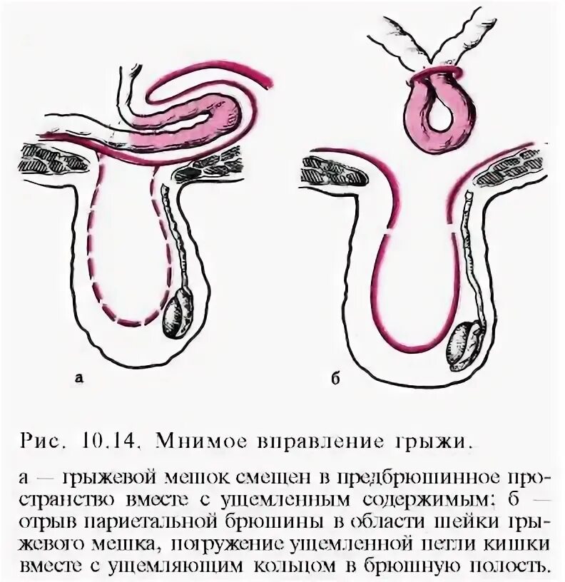 Вправление ущемленной грыжи. Мнимое вправление и ложное ущемление грыжи. Грыж мнимое вправление грыжи. Ложное ущемление грыжа Брока. Ложное вправление ущемленной грыжи.