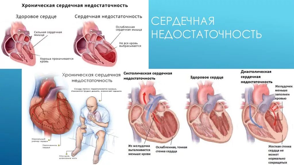 Что значит застойная сердечная недостаточность. Симптомы острой сердечной недостаточности. Острая хроническая недостаточность сердца. Хроническая сердечная недостаточность ХСН это. Стадии острой сердечной недостаточности.