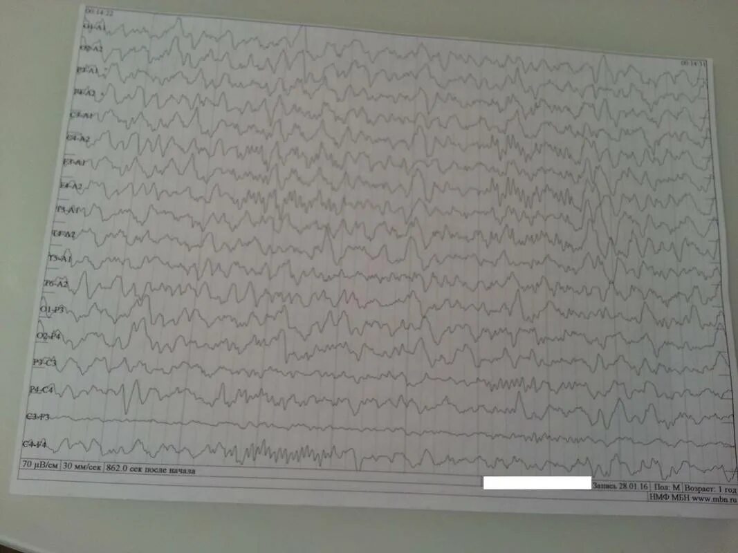 Плохое ээг. ЭЭГ здорового ребенка 2 года. ЭЭГ 1965. ЭЭГ здорового реленкамв 3 года. ЭЭГ здорового ребенка 1 год.