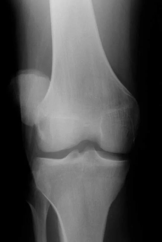 Латерализация надколенника. Подвывих коленного сустава рентген. Подвывих коленной чашки. Вывих коленного сустава рентген. Вывих надколенника рентгенограммы.
