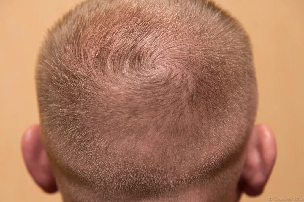 Затылок темя. Залысина на макушке у мужчин. Залысина на макушке у мужчин. Точка на макушке головы бай хуэй. Зоны головы для парикмахеров.
