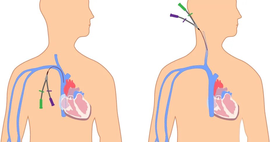 Периферическая вена где. Центральный венозный катетер подключичный. Центральный венозный катетер осложнения. ЦВК Центральный венозный катетер. Центральные венозные катетеры порт система.