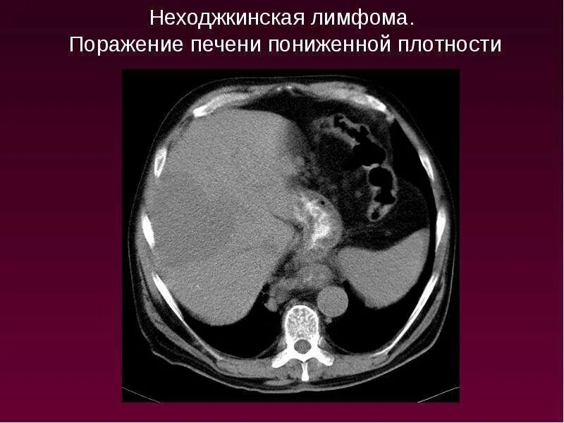 Неходжкинская лимфома гистология. Подмышечные лимфоузлы на кт. Неходжкинские лимфомы. Костный мозг при лимфоме. Неходжкинские лимфомы кт.