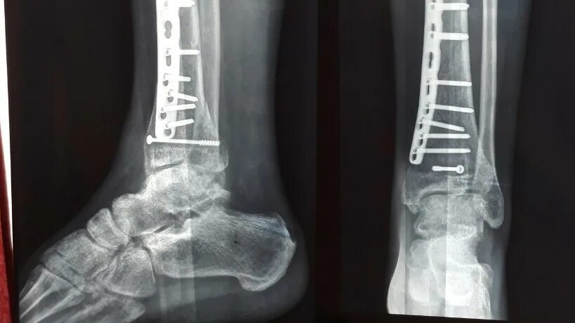 Косой перелом малоберцовой кости. Перелом малоберцовой кости со смещением. Малоберцовая кость перелом косой. Перелом малоберцовой кости со смещением и захождением. Перелом н 3