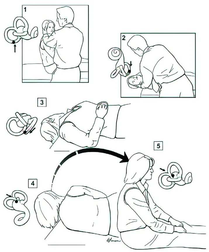 Проба холпайка. Вестибулярная гимнастика маневр Эпли. ДППГ прием Эпли. Доброкачественное позиционное головокружение манёвр Эпли. Гимнастика Эппле при головокружении.