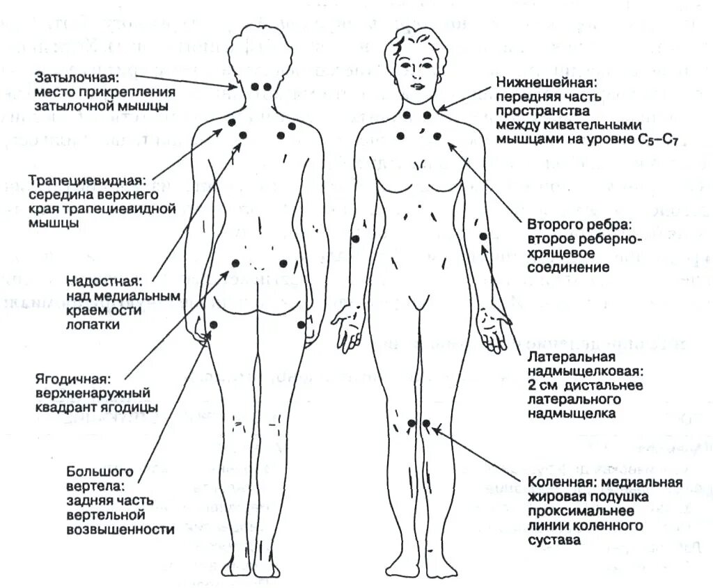 18 болезненный. Фибромиалгия триггерные точки. Фибромиалгия триггерные точки схема. Болевые точки при фибромиалгии. Схема триггерных точек у человека.