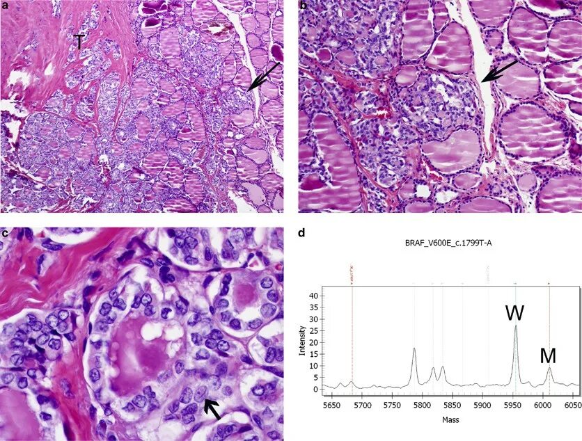 Изменение тканей щитовидной железы. Щитовидная железа гистология препарат. Клетки щитовидной железы гистология. Гемангиома щитовидной железы гистология. 49. Щитовидная железа. Гистология.