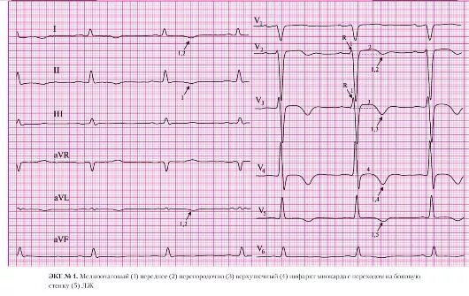 Клиника мелкоочагового инфаркта миокарда. Отрицательный зубец т при инфаркте миокарда. Подострая стадия инфаркта миокарда на ЭКГ. Инфаркт миокарда зубцы на ЭКГ. Изменения в нижней стенке левого желудочка