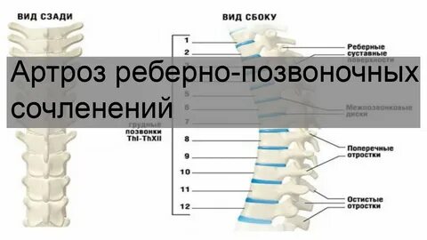 Артроз реберно позвоночных лечение