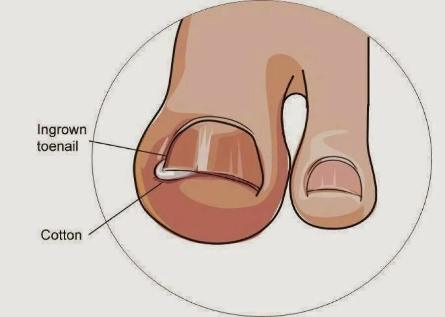Впился ноготь что делать. Краевая резекция вросшего ногтя нагноение. Схема врастания ногтя на ноге.