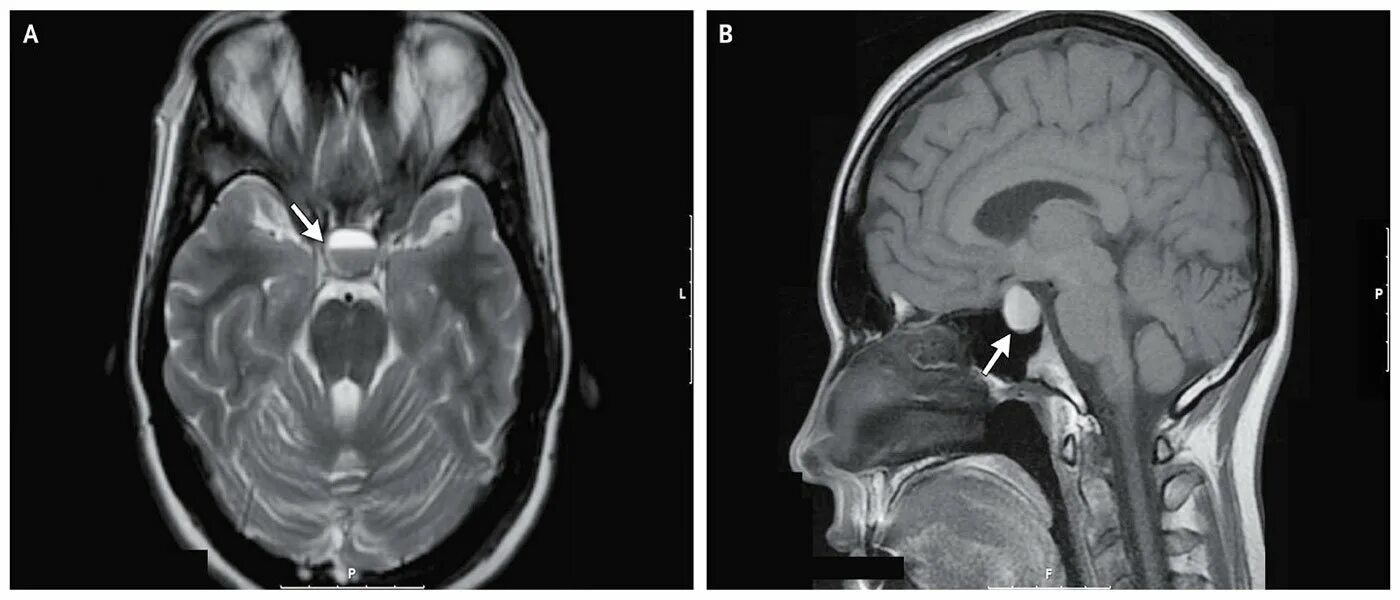 Образование турецкого седла. Микроаденома гипофиза мрт. Аденома гипофиза мрт. Аденома гипофиза кт. Аденома гипофиза снимок мрт.