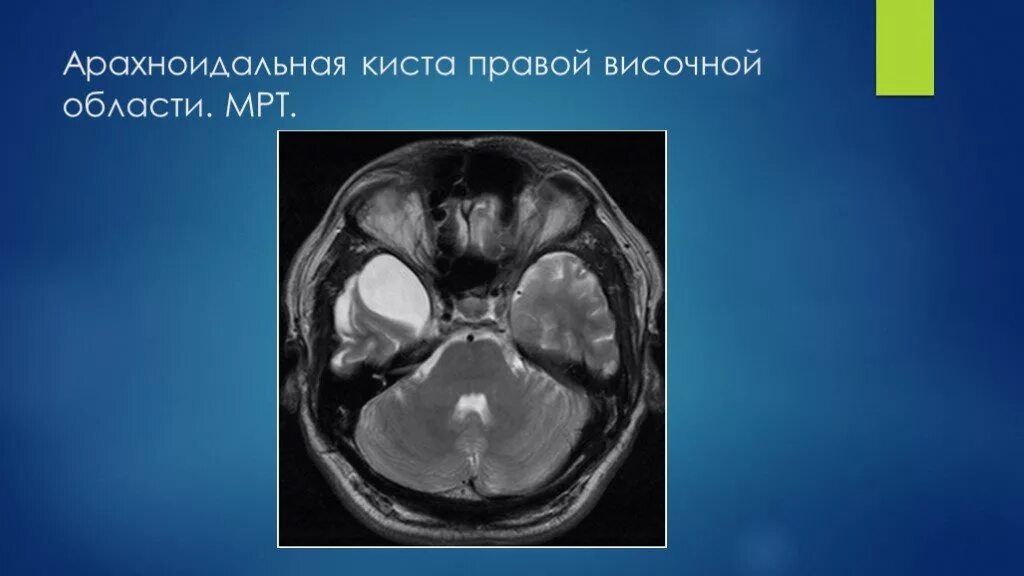 Височная киста головного мозга. Арахноидальные кисты височных областей мрт. Арахноидальное киста головного мозга. Ретроцеребральная киста кт. Арахноидальная киста левой височной доли кт.