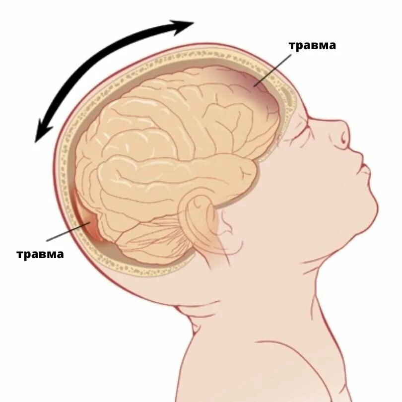 Синдром тряски. Родовая травма и гидроцефалия. Родовая черепно мозговая травма. Внутричерепная родовая травма.