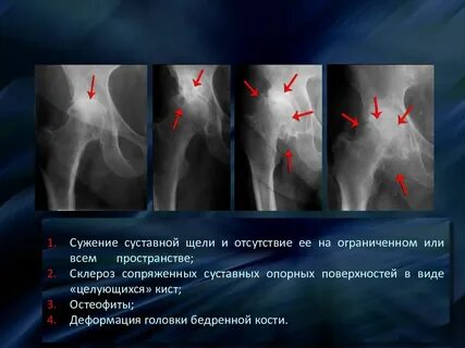 Ширина суставная щель тазобедренного сустава