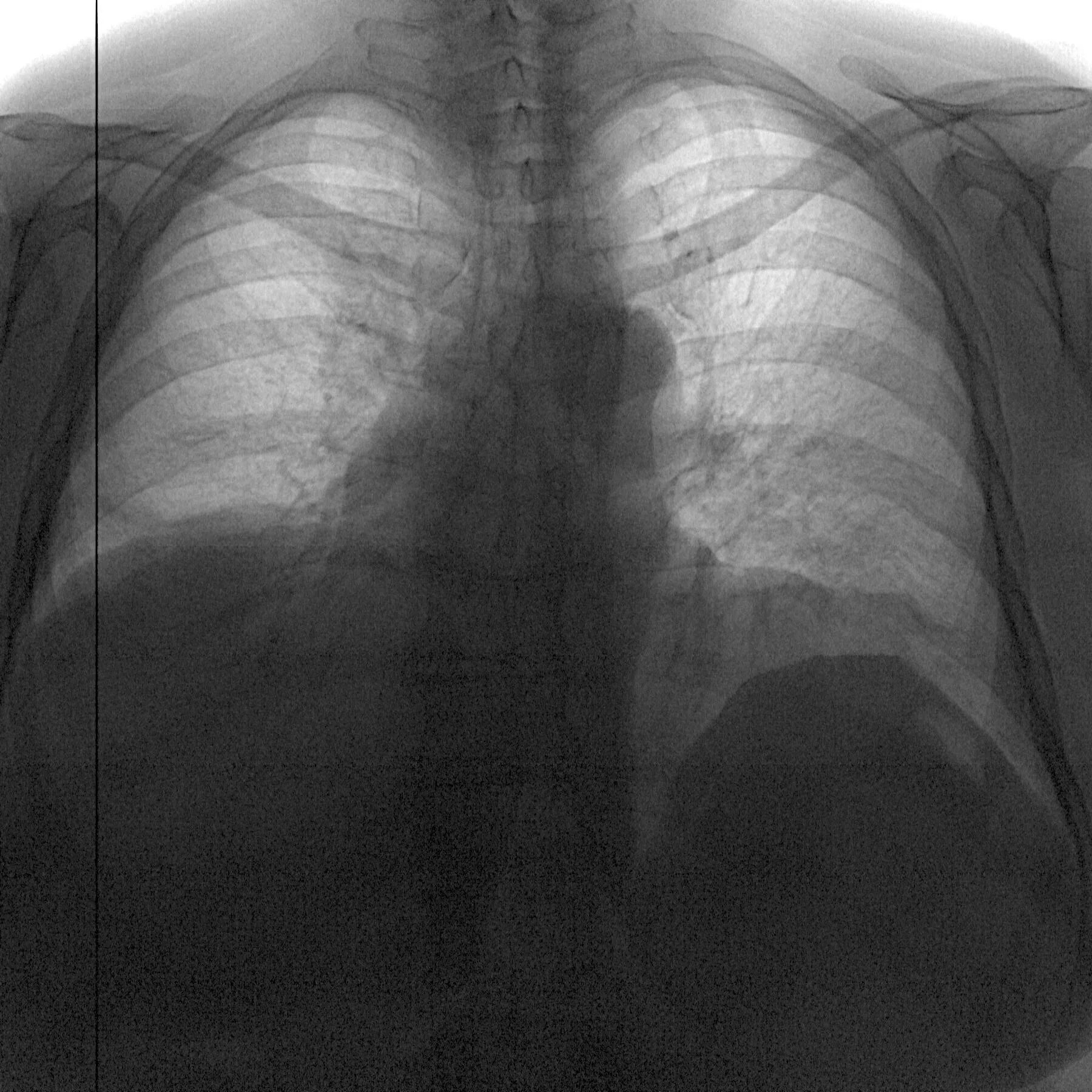 Спадение бронха