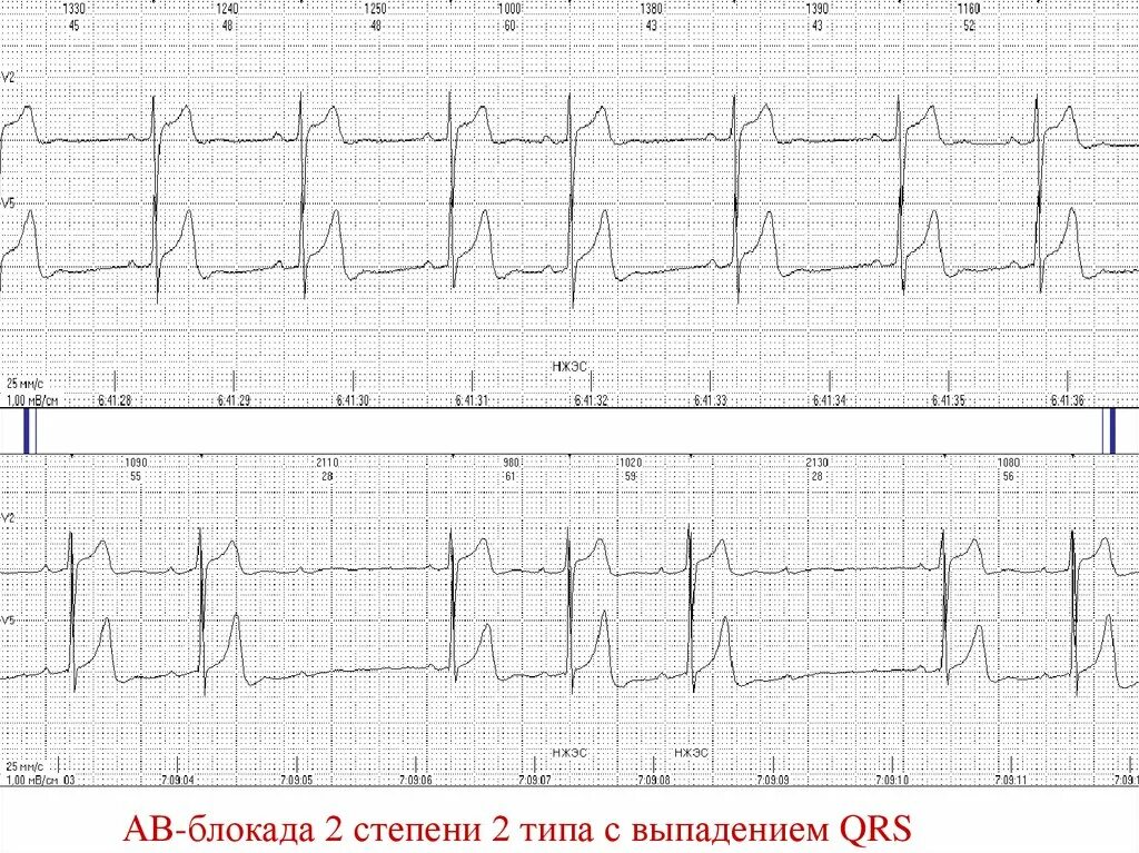 Атриовентрикулярная блокада 2. АВ блокада 2 степени типа Мобитц 2. АВ блокада 2 степени Мобитц 2 на ЭКГ. АВ блокада 2 степени Мобиц 1 на ЭКГ. ЭКГ av блокада Мобиц 2.