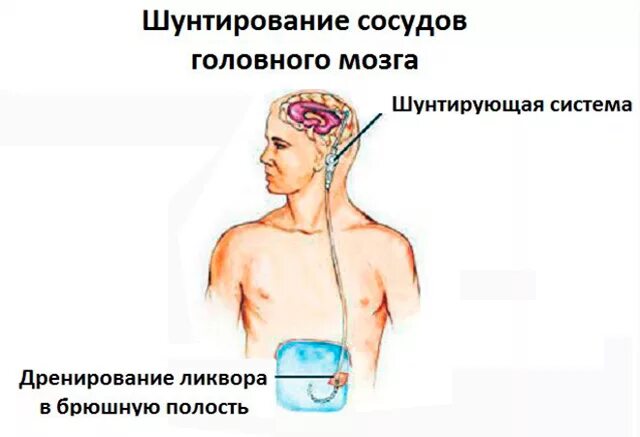 Шунтирование желудочков мозга. Шунтирование гидроцефалии головного. Шунтирование гидроцефалии вентрикулоперитонеальное.