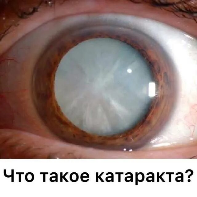 Вывих хрусталика. Вывих хрусталика