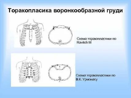 Торакопластика