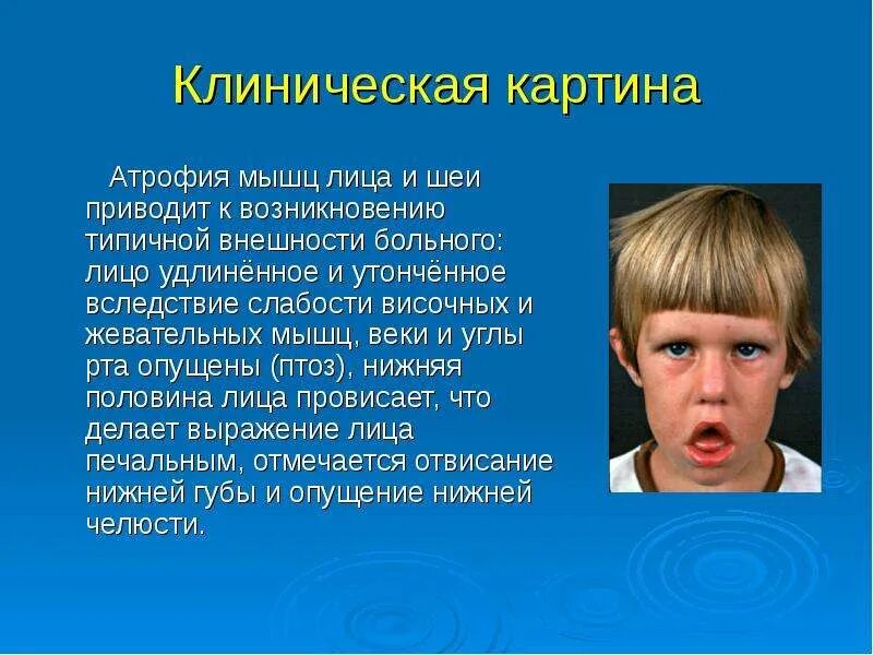 Атрофия жевательных мышц. Мышцы лица атрофированы.