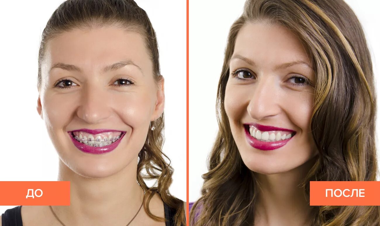 Зубы после 30. Исправление кривых зубов. Зубы после брекетов до и после.
