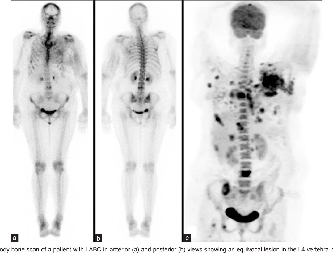 ПЭТ кт метастазы в костях. Остеосцинтиграфия и ПЭТ кт. Остеосцинтиграфия метастазы. Сцинтиграфия костей метастазы. Рфп при пэт кт