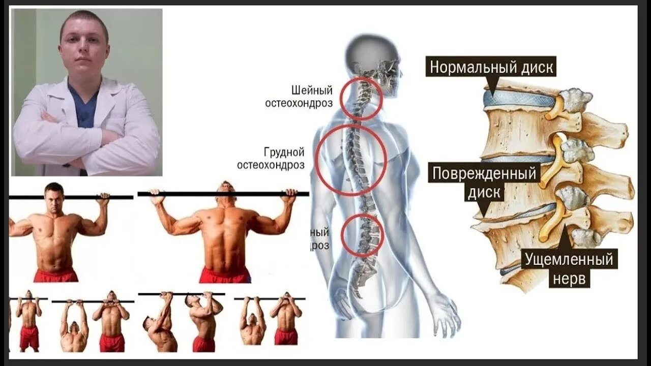 Упражнения на турнике для позвоночника при остеохондрозе. Занятия на турнике при остеохондрозе. Упражнения для грыжи позвоночника на турнике. Упражнение на турнике для спины при остеохондрозе шейного.