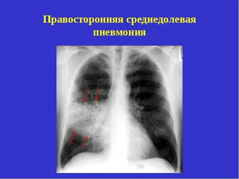 Правосторонняя нижнедолевая очаговая пневмония рентген. Пневмония средней доли рентген. Пневмония средней доли правого легкого рентген. Правосторонняя очаговая пневмония рентген. Пневмония в нижней доле правого легкого