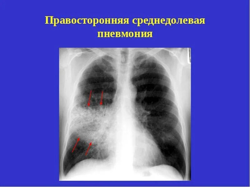 Правосторонняя нижнедолевая пневмония рентген. Внебольничная очаговая пневмония рентген. Правосторонняя очаговая пневмония рентген. Правосторонняя нижнедолевая крупозная пневмония рентген. Левосторонняя нижнедолевая пневмония рентген.