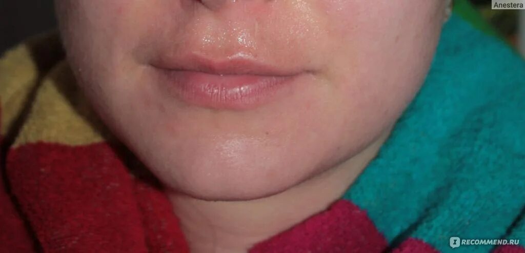 Раздражение носа от насморка. Покраснение вокруг рта. Аллергия вокруг рта и носа.
