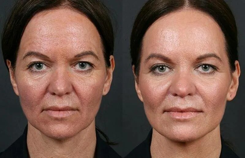 Пилинг после солярия. Тса 20 пилинг. кислотный пилинг для лица до и после.