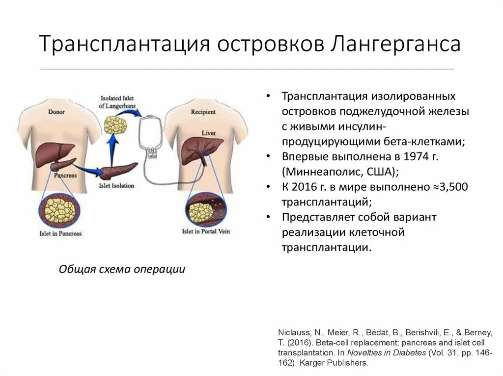 Трансплантация поджелудочной железы при сахарном диабете 1 типа. Пересадка бета клеток поджелудочной железы. Трансплантация культуры островковых клеток поджелудочной железы. Пересадка поджелудочной железы при сахарном диабете 1 типа. Пересадка поджелудочной в россии