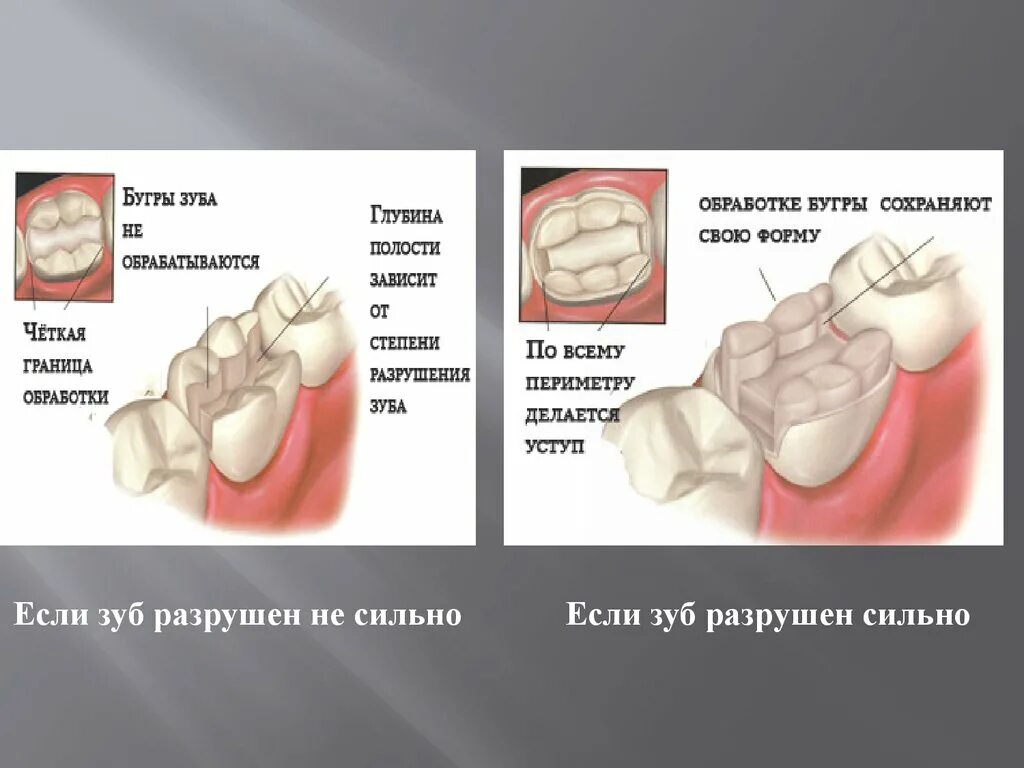 Почему сильно зуб. Сильное разрушение зубов. Растущение зуба мудрости.