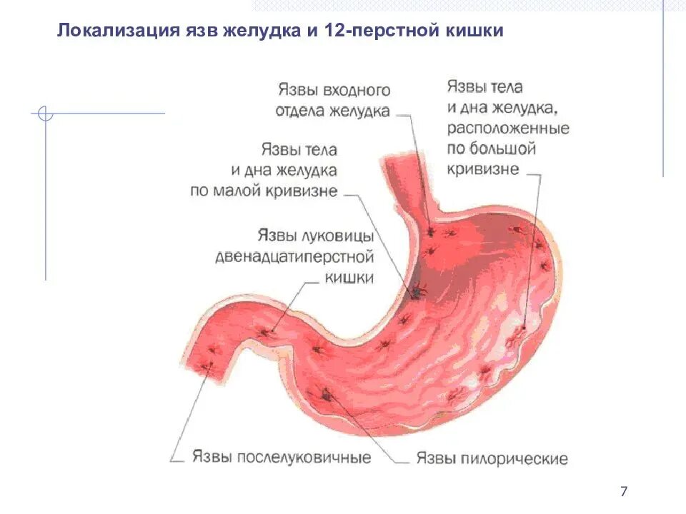 Шум плеска нижняя граница желудка. Плеск в желудке. Определение шума плеска. Плеск в желудке. Метод определения шума плеска желудка.