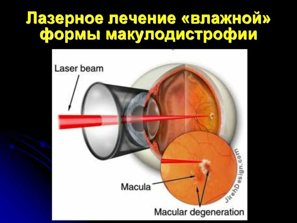 Фокальная лазеркоагуляция сетчатки глаза. Фокальная лазерная коагуляция сетчатки глаза. Ограничительная лазеркоагуляция сетчатки глаза. Макулодистрофия, макулярная дегенерация.