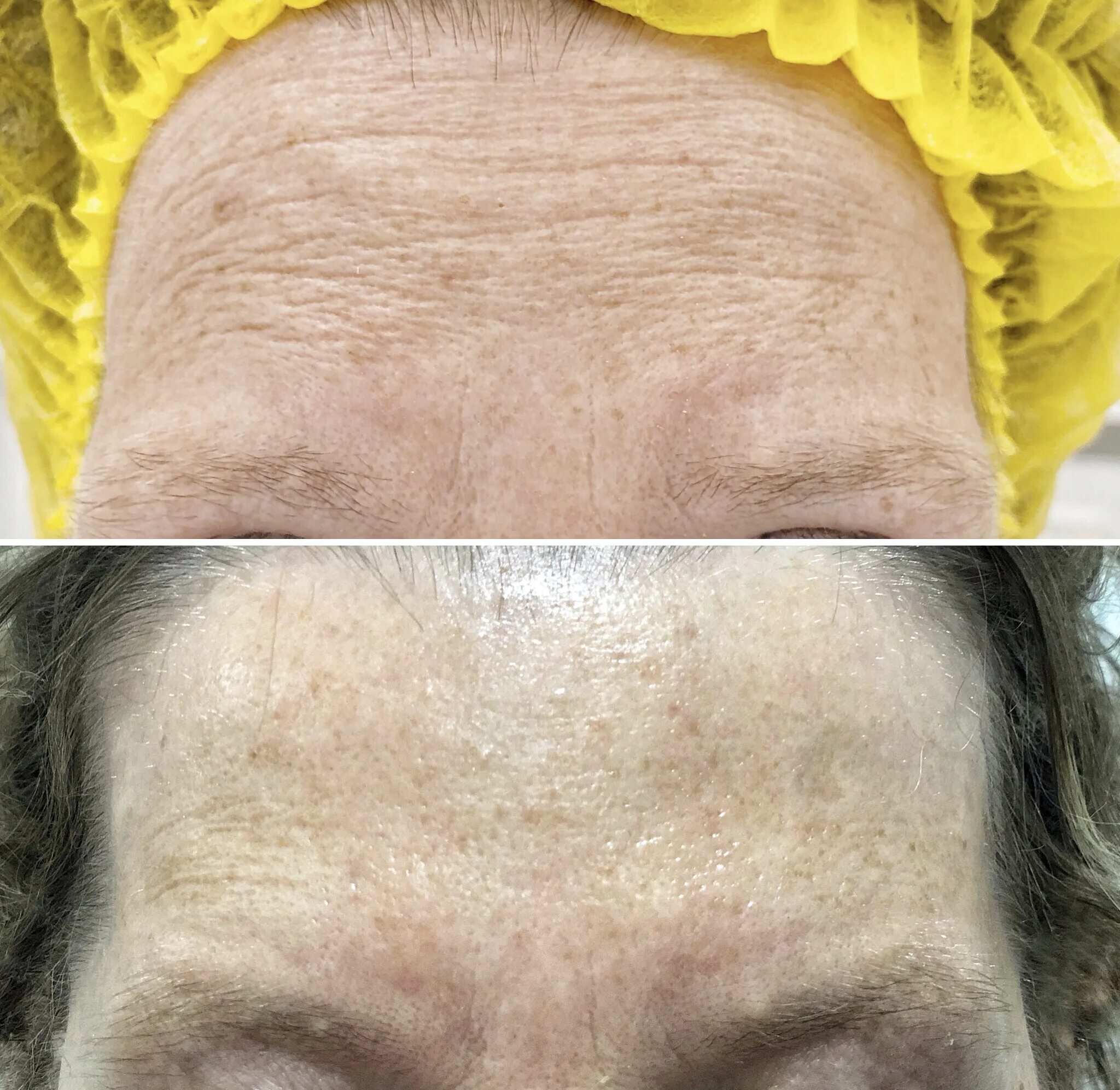 Ботулинотерапия лица отзывы. Ботулинотерапия в косметологии лоб до и после. Ботулинотерапия глаз до и после. Кожа после ботулинотерапии. Бутолинотерапия фото до и после.
